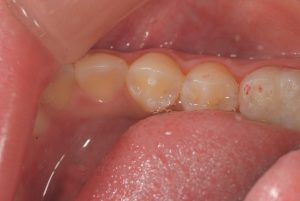 乳歯からの生え換わりでご注意を 中心結節 サン スマイル歯科