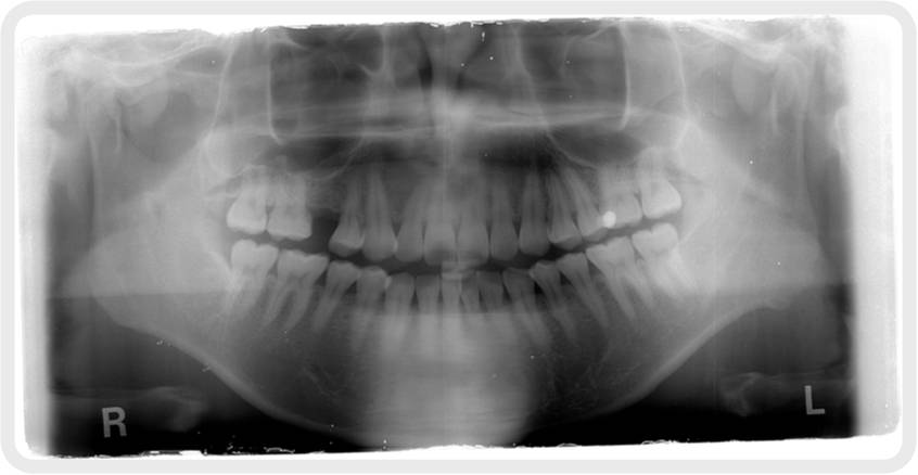 治療の道しるべ、X線写真について | サン・スマイル歯科