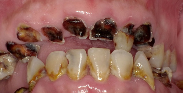 歯髄保存療法 Mta サン スマイル歯科