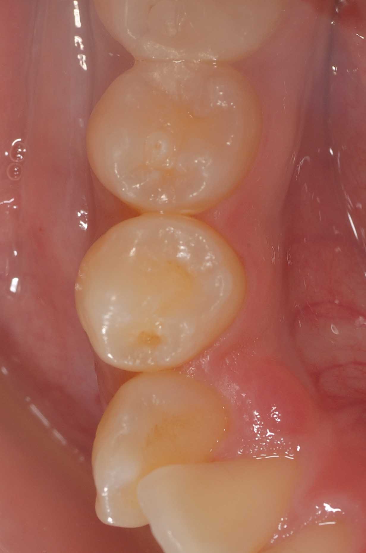 レントゲン X線写真 って ほんとうにいるの サン スマイル歯科